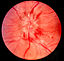 Papilledema.jpg