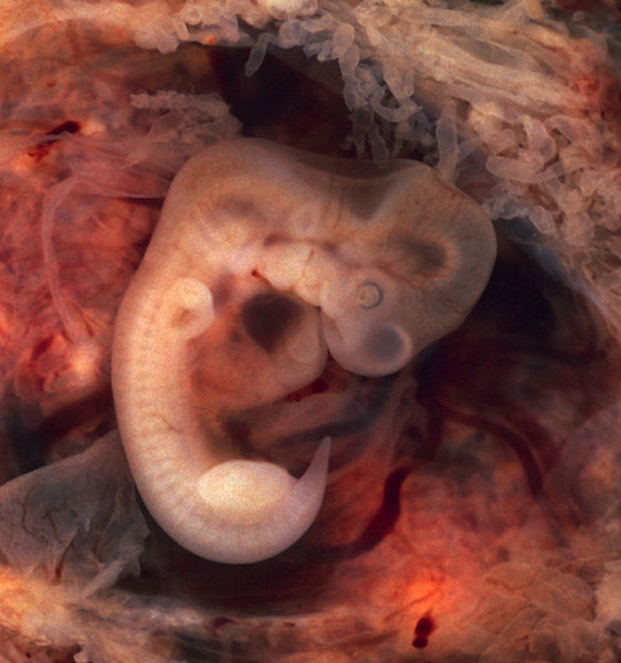 Datei:Tubal Pregnancy with embryo.jpg