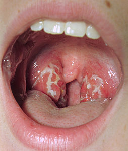 A culture positive case of streptococcal pharyngitis with typical tonsillar exudate in a 16 year old.