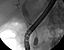 ERCP cholangioca.jpg