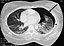 Pneumothorax CT.jpg