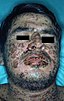 Stevens-johnson-syndrome.jpg
