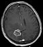 Hirnmetastase MRT-T1 KM.jpg