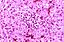 Reye's syndrome liver-histology.jpg