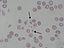 Schizocyte smear 2009-12-22.JPG