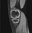 OCD WalterReed MRI-Sagital-T1.jpeg