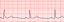 Sinus bradycardia lead2.svg